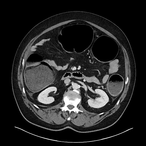 Obstructing sigmoid adenocarcinoma (Radiopaedia 58465-65619 A 68).jpg