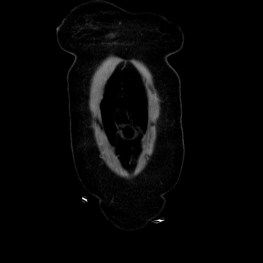 Obstructive distal colonic adenocarcinoma causing cecal perforation (Radiopaedia 86830-102989 C 38).jpg