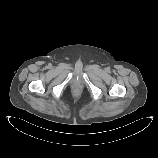 File:Obstructive pyelonephritis (Radiopaedia 46411-50844 Axial non-contrast 84).png