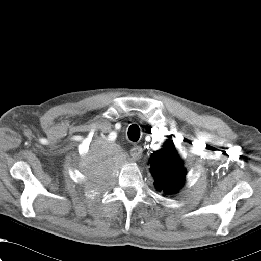 File:Obstructive superior vena cava tumor thrombus (Radiopaedia 28046-28306 A 6).jpg