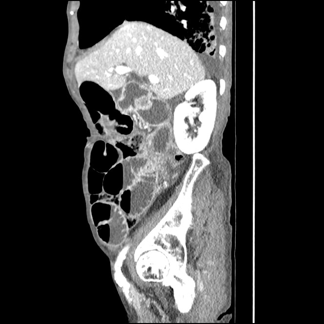 Obturator hernia causing small bowel obstruction (Radiopaedia 65522-74612 C 71).jpg