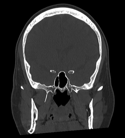 Occipital spur and Currarino type A atlas anomaly (Radiopaedia 87027-103285 Coronal bone window 68).jpg