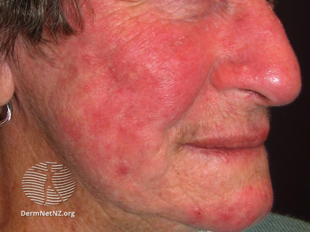 Rosacea (DermNet NZ acne-red-face-3629).jpg