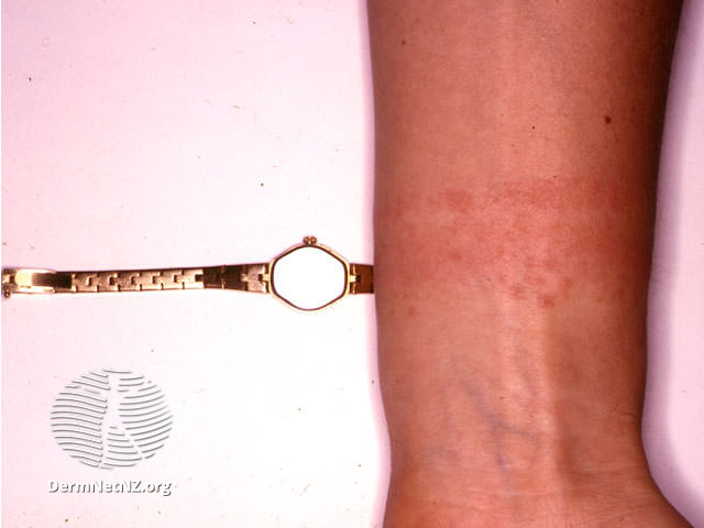File:Watch strap reaction (DermNet NZ dermatitis-acdnic).jpg
