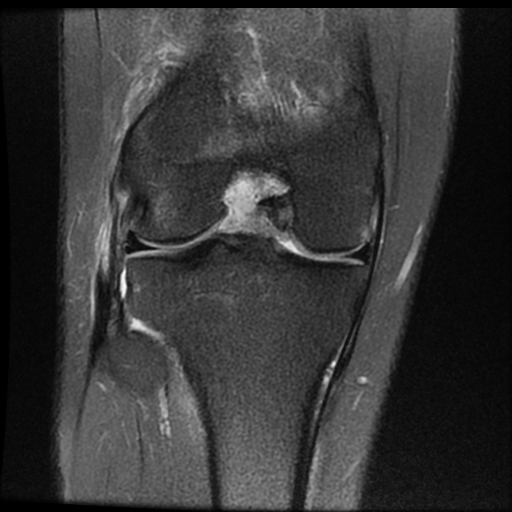 File:ACL acute full thickness tear - deep lateral femoral sulcus sign (Radiopaedia 38594-40740 Coronal PD fat sat 13).jpg