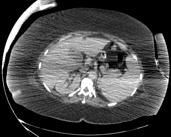 File:Abdominal abscess - pre and post percutaneous drainage (Radiopaedia 60209-67816 Axial 75).png