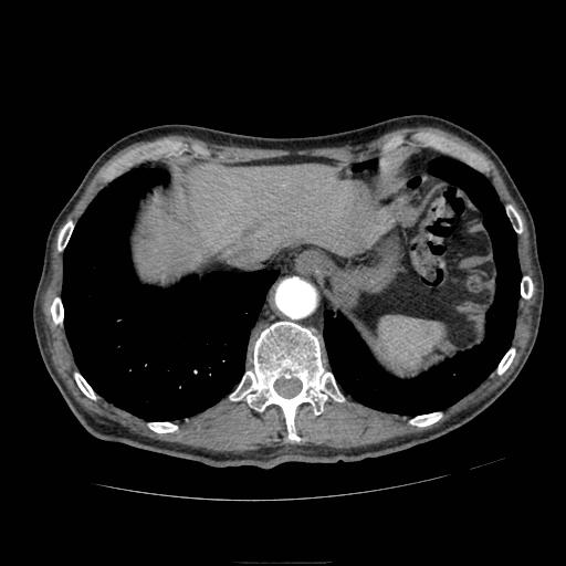 Abdominal aortic aneurysm (Radiopaedia 13341-13340 Axial C+ arterial phase 18).jpg