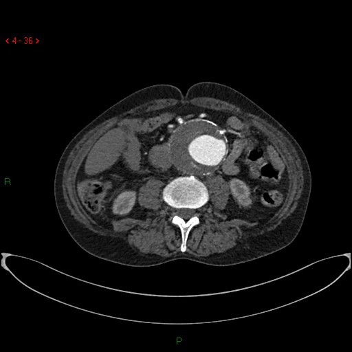 File:Abdominal aortic aneurysm (Radiopaedia 16155-15834 Axial C+ arterial phase 16).jpg