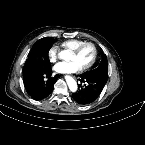 Abdominal aortic aneurysm (Radiopaedia 67117-76452 Axial C+ arterial phase 4).jpg