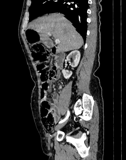 Abdominal aortic aneurysm (Radiopaedia 83581-98689 Sagittal C+ arterial phase 8).jpg