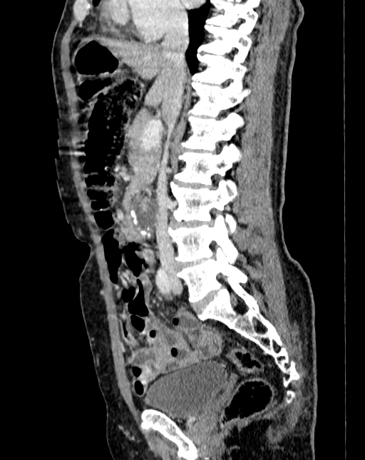Abdominal aortic aneurysm (Radiopaedia 83581-98689 Sagittal C+ portal venous phase 38).jpg