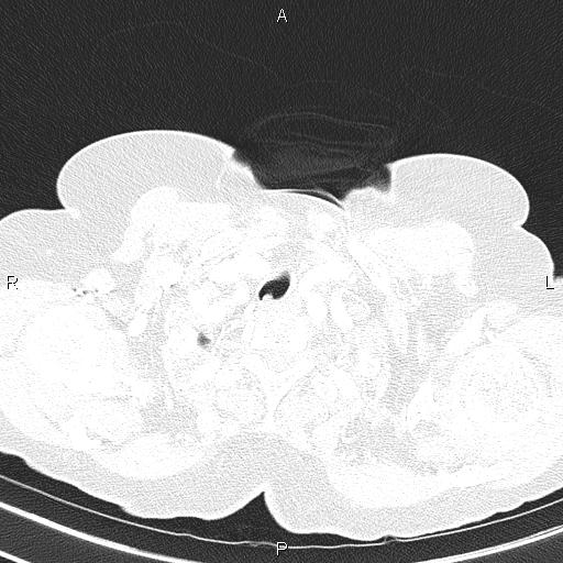 Abdominal aortic aneurysm (Radiopaedia 85063-100606 Axial lung window 10).jpg