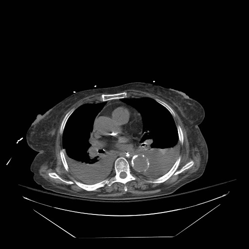 Abdominal aortic aneurysm - impending rupture (Radiopaedia 19233-19247 Axial non-contrast 3).jpg