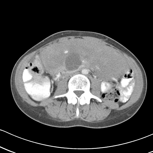 File:Abdominal desmoid tumor (Radiopaedia 41007-43740 Axial C+ portal venous phase 35).png