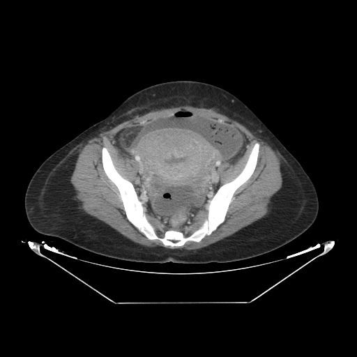 Abdominal gossypiboma- surgical towel (Radiopaedia 57288-64226 Axial C+ portal venous phase 63).jpg