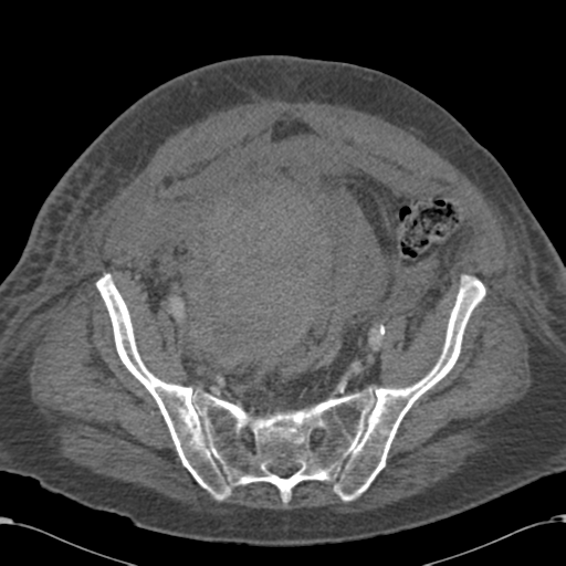 File:Abdominal hematoma (Radiopaedia 33614-34715 Axial C+ portal venous phase 101).png