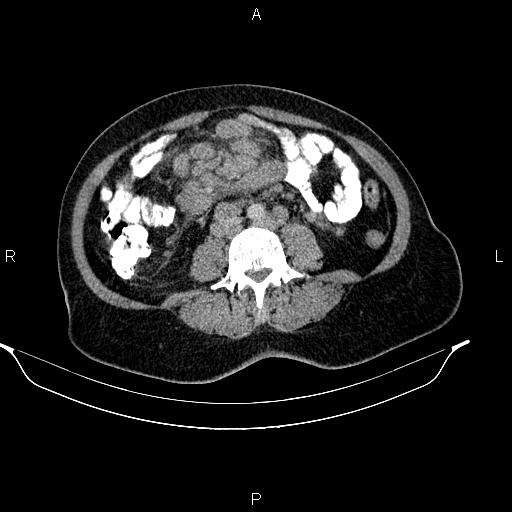 Abdominal lymphoma with sandwich sign (Radiopaedia 84378-99704 Axial C+ portal venous phase 34).jpg