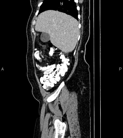 Abdominal lymphoma with sandwich sign (Radiopaedia 84378-99704 Sagittal C+ portal venous phase 9).jpg
