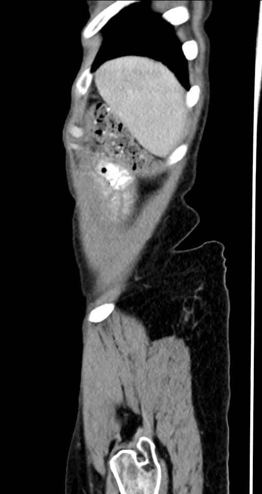 Abdominal wall and retroperitoneal tuberculosis (Radiopaedia 88137-104729 Sagittal C+ portal venous phase 19).jpg