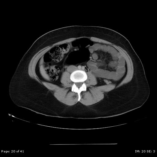 File:Abdominal wall endometriosis (Radiopaedia 25723-25885 Axial C+ portal venous phase 20).jpg