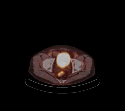 Abdominal wall metastasis from colorectal carcinoma (Radiopaedia 31016-31719 C 28).jpg