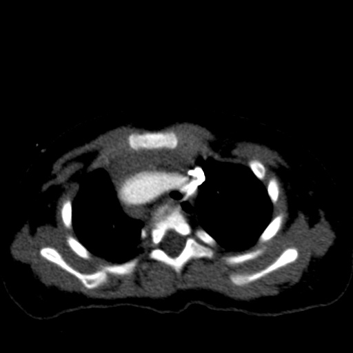 File:Aberrant left pulmonary artery (pulmonary sling) (Radiopaedia 42323-45435 Axial C+ CTPA 14).jpg