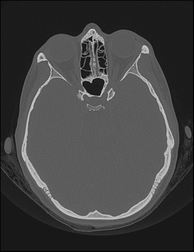 Aberrant right internal carotid artery (Radiopaedia 65191-74198 Axial non-contrast 70).jpg