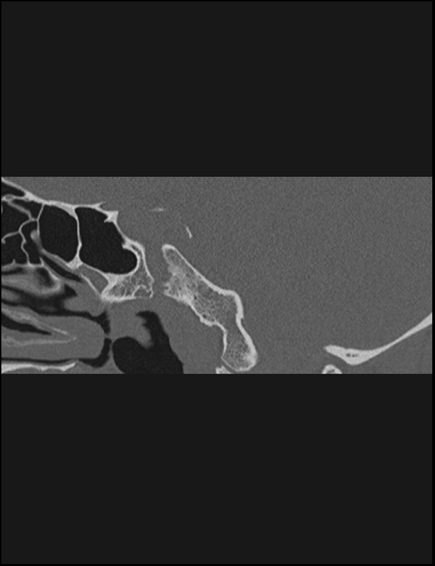 Aberrant right internal carotid artery (Radiopaedia 65191-74198 Sagittal non-contrast 89).jpg