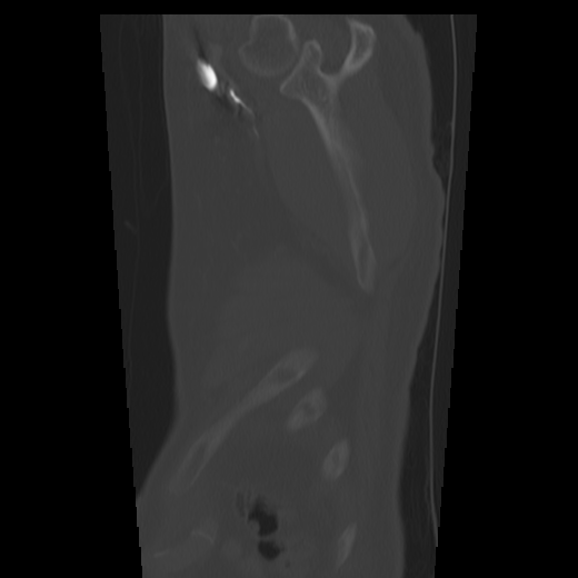 Aberrant right subclavian artery (arteria lusoria) (Radiopaedia 66584-75879 Sagittal C+ arterial phase 81).png