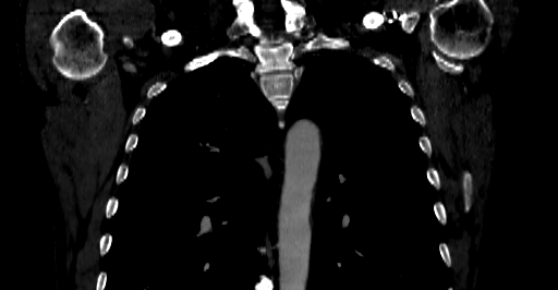 Accesory rib joint (Radiopaedia 71987-82452 Coronal bone window 12).jpg