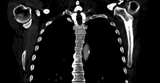 File:Accesory rib joint (Radiopaedia 71987-82452 Coronal bone window 30).jpg