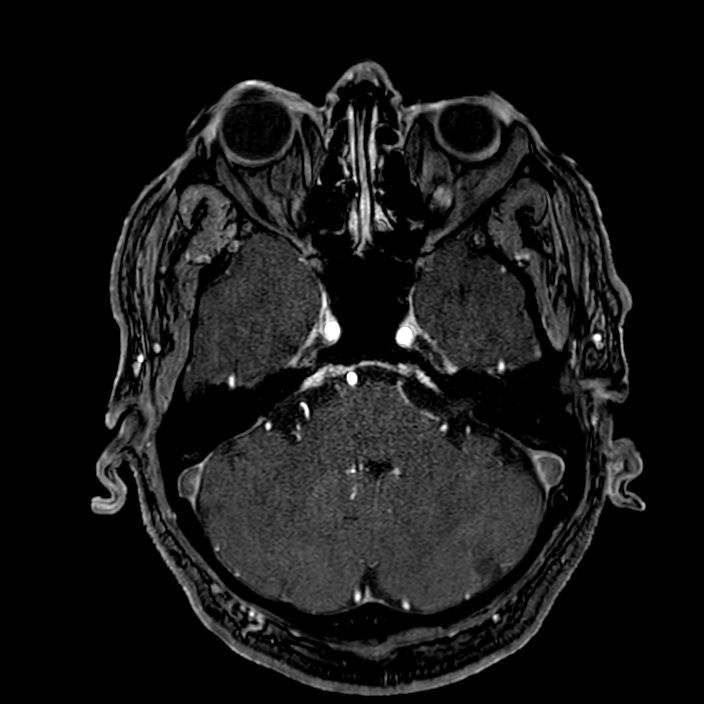 Accessory middle cerebral artery (Radiopaedia 73114-83828 Axial MRA 39).jpg