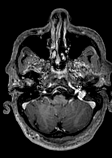 Accessory middle cerebral artery (Radiopaedia 73114-83828 Axial T1 C+ 149).jpg
