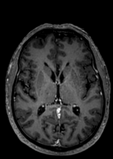 Accessory middle cerebral artery (Radiopaedia 73114-83828 Axial T1 C+ 24).jpg