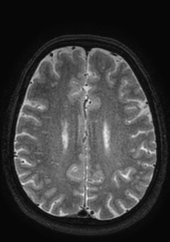 Accessory middle cerebral artery (Radiopaedia 73114-83828 Axial T2 9).jpg