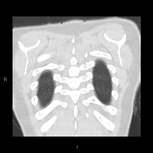 Accidental foreign body aspiration (seamstress needle) (Radiopaedia 77740-89983 Coronal lung window 3).jpg