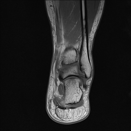 File:Achilles tendon tear (Radiopaedia 77615-89819 Coronal T1 20).jpg