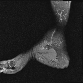 File:Achilles tendon tear (Radiopaedia 77615-89819 Sagittal PD fat sat 2).jpg