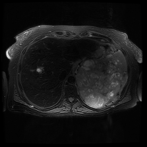 File:Acinar cell carcinoma of the pancreas (Radiopaedia 75442-86668 Axial T2 fat sat 18).jpg