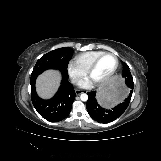 File:Acinar cell carcinoma of the pancreas (Radiopaedia 75442-86669 Axial C+ portal venous phase 6).jpg