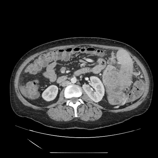 Acinar cell carcinoma of the pancreas (Radiopaedia 75442-86669 Axial C+ portal venous phase 70).jpg