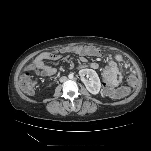 Acinar cell carcinoma of the pancreas (Radiopaedia 75442-86669 Axial C+ portal venous phase 77).jpg