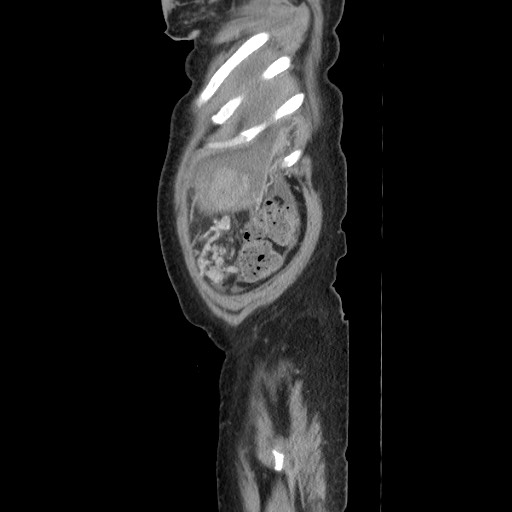Acinar cell carcinoma of the pancreas (Radiopaedia 75442-86669 Sagittal C+ portal venous phase 176).jpg