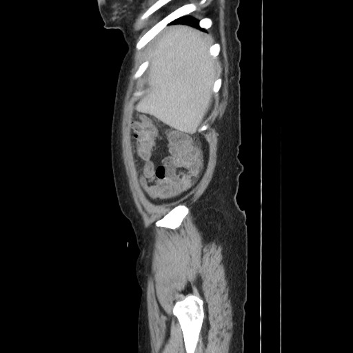 Acinar cell carcinoma of the pancreas (Radiopaedia 75442-86669 Sagittal C+ portal venous phase 36).jpg