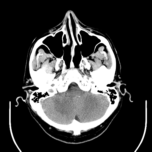 File:Acoustic schwannoma (Radiopaedia 39170-41388 Axial non-contrast 9).png