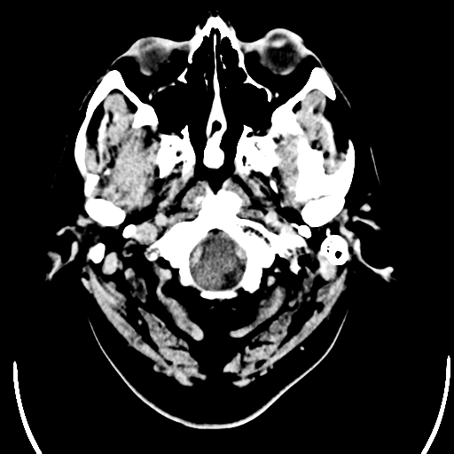 File:Acoustic schwannoma (Radiopaedia 39170-41389 Axial C+ 1).png