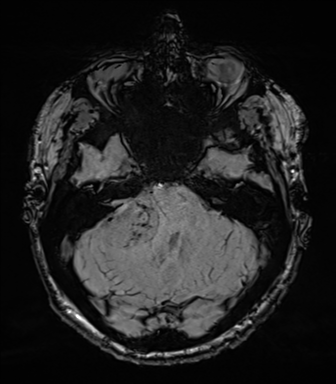 File:Acoustic schwannoma (Radiopaedia 50846-56358 Axial SWI 25).png