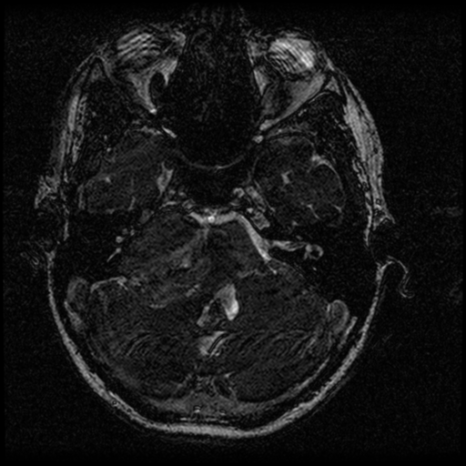 Acoustic schwannoma - eroding petrous apex (Radiopaedia 39674-42004 Axial T2 37).png