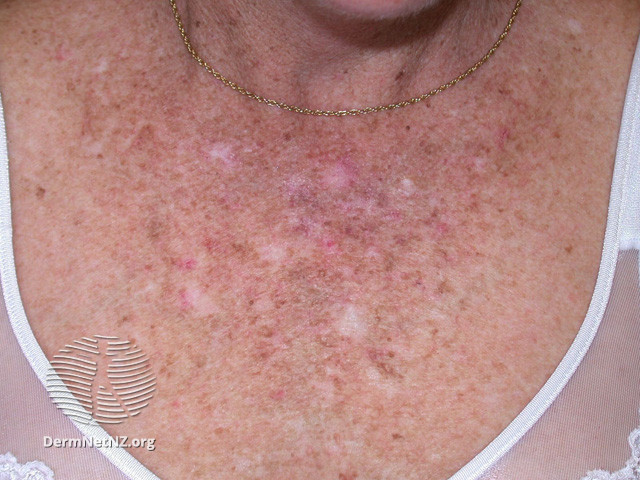 Actinic Keratoses affecting the face (DermNet NZ lesions-ak-face-479).jpg