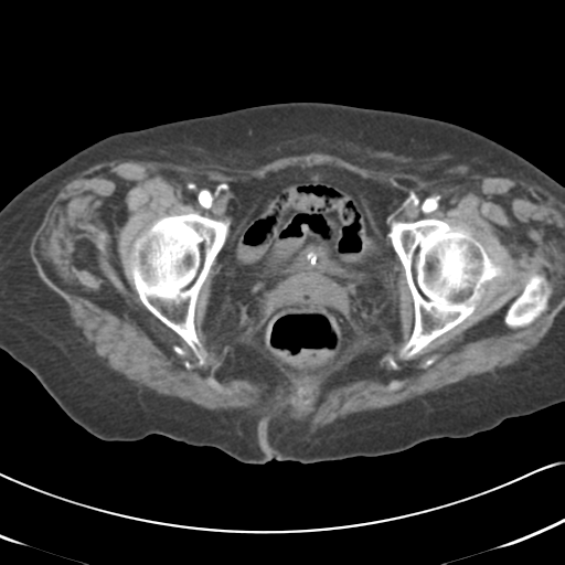 Active bleeding from duodenal ulcer with embolization (Radiopaedia 34216-35481 Axial C+ arterial phase 63).png